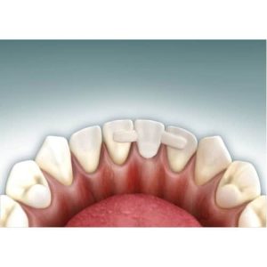 Benzi de fibra de sticla - Dentapreg PFM